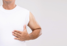 Gynecomastia
